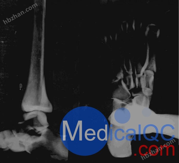 美国RSD RS-116脚模体